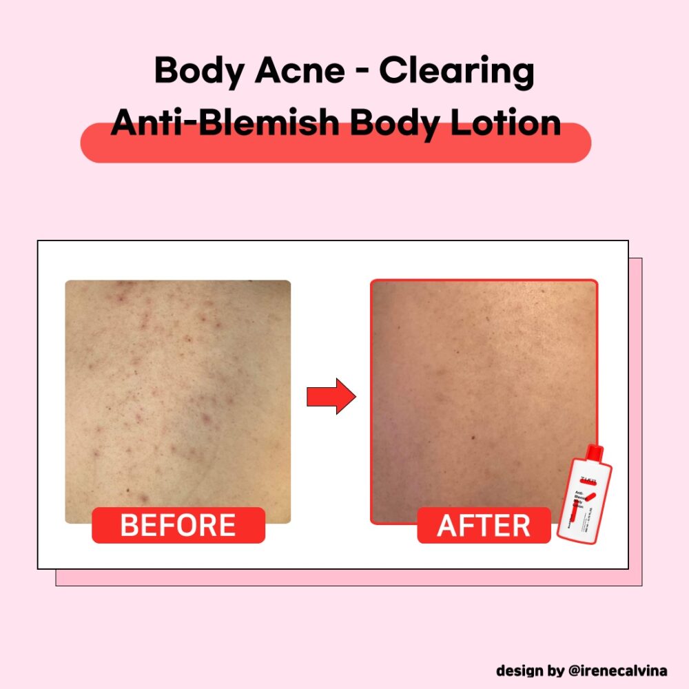 TIAM Anti Blemish Body Lotion 200 ml